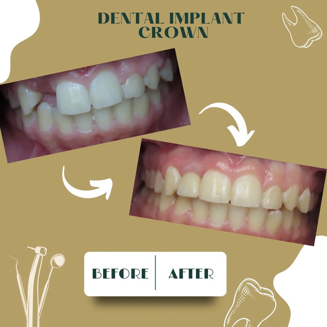 Dental clinical case 1, before and after